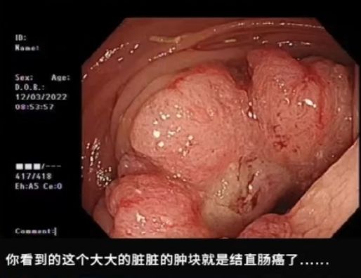 這種息肉可能會(huì)變成癌！排便出現(xiàn)這4種異常建議及時(shí)就醫(yī)