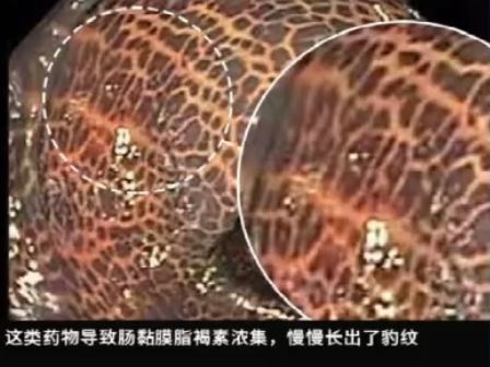 這種息肉可能會(huì)變成癌！排便出現(xiàn)這4種異常建議及時(shí)就醫(yī)