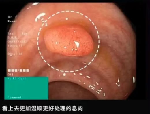 這種息肉可能會(huì)變成癌！排便出現(xiàn)這4種異常建議及時(shí)就醫(yī)