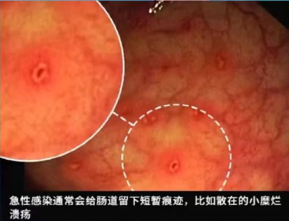 這種息肉可能會(huì)變成癌！排便出現(xiàn)這4種異常建議及時(shí)就醫(yī)