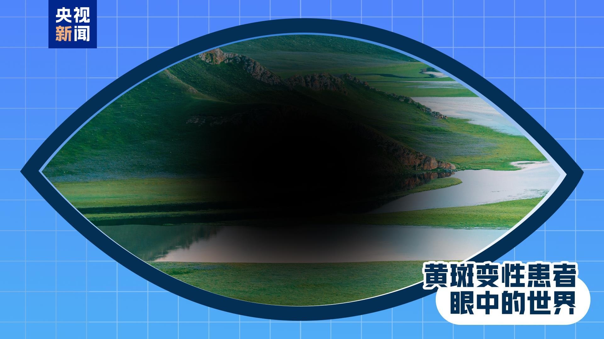 全國(guó)愛(ài)眼日丨出現(xiàn)這些癥狀 是眼睛在報(bào)警！